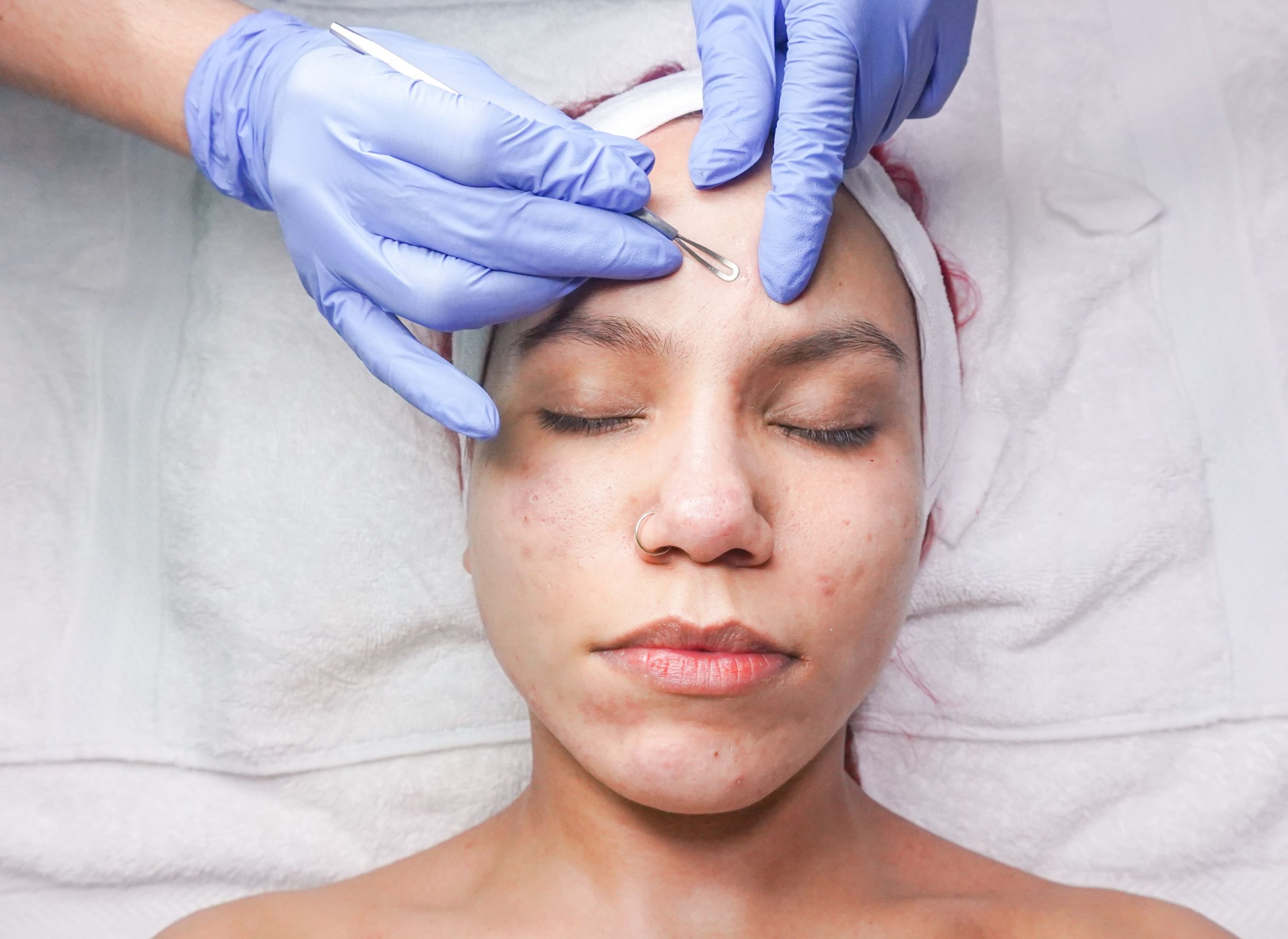 Professionelle Behandlung bei Akne und unreiner Haut bei Laser Aesthetic Heidelberg