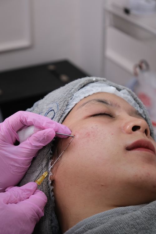 Microneedling im kosmetischen Institut als Teil der individuellen Behandlung